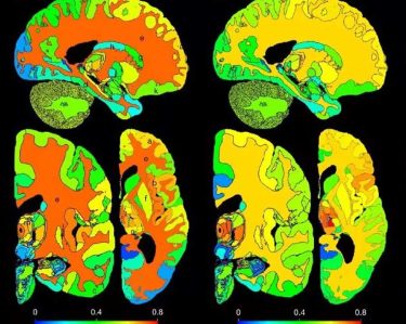 NextBrain: l'atles Cerebral més complet amb participació de VICOROB